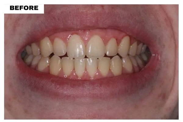 Antes del tratamiento dental