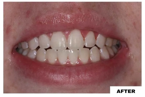 Después del tratamiento dental