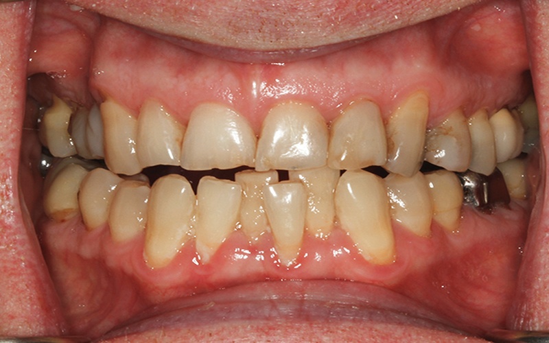 Dientes apiñados - EDENT