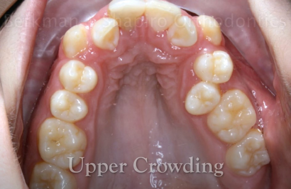Dientes apiñados