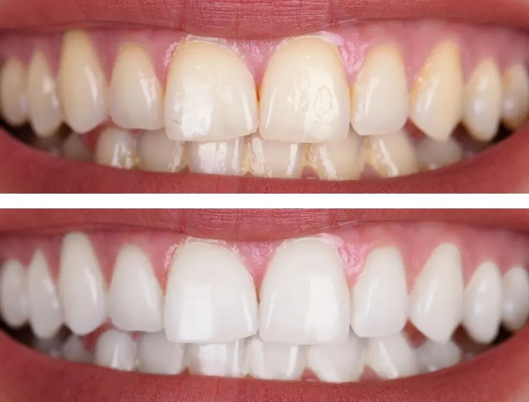 Blanqueamiento dental